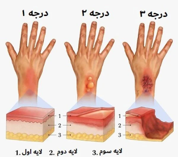 انواع زخم سوختگی